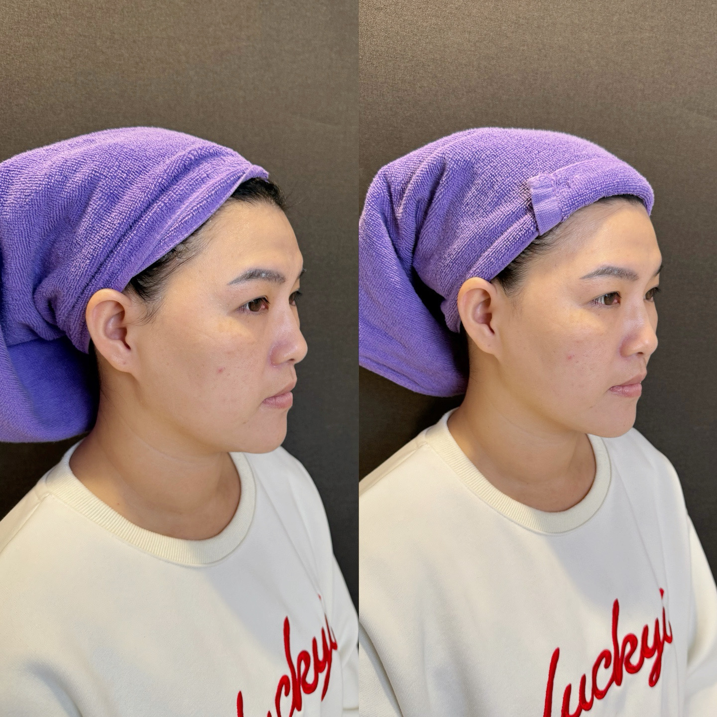 打造上鏡輪廓-愛爾麗忠孝店雙子星極線音波一試就懂 - 第7張圖 打造上鏡輪廓-愛爾麗忠孝店雙子星極線音波一試就懂